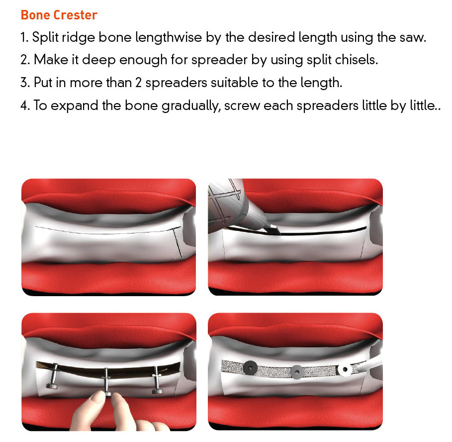 Split Master Bone Crester